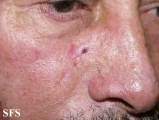 basal cell carcinoma