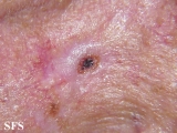 basal cell carcinoma