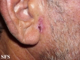 basal cell carcinoma