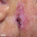 basal cell carcinoma