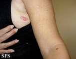 basal cell carcinoma