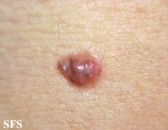 basal cell carcinoma