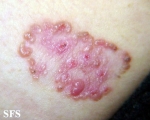 basal cell carcinoma
