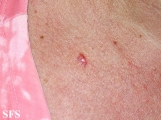 basal cell carcinoma