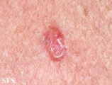 basal cell carcinoma