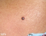 basal cell carcinoma