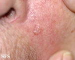 basal cell carcinoma