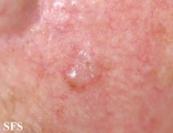 basal cell carcinoma