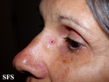 basal cell carcinoma