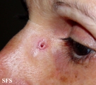 basal cell carcinoma