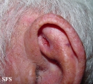 basal cell carcinoma
