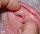 basal cell carcinoma