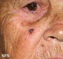 basal cell carcinoma