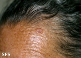 basal cell carcinoma