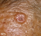 basal cell carcinoma