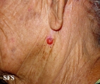 basal cell carcinoma