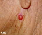 basal cell carcinoma