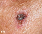 basal cell carcinoma