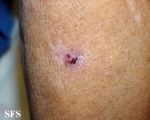 basal cell carcinoma