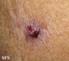basal cell carcinoma