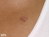 basal cell carcinoma