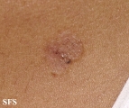 basal cell carcinoma
