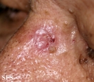 basal cell carcinoma