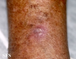 basal cell carcinoma