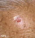basal cell carcinoma