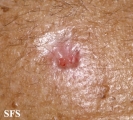 basal cell carcinoma