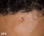 basal cell carcinoma