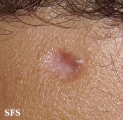 basal cell carcinoma