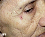 basal cell carcinoma
