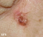 basal cell carcinoma