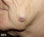 basal cell carcinoma