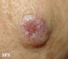 basal cell carcinoma