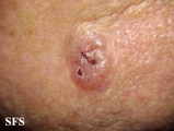 basal cell carcinoma