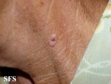 basal cell carcinoma