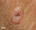 basal cell carcinoma