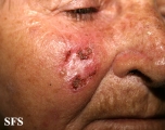 basal cell carcinoma