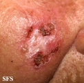 basal cell carcinoma