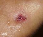 basal cell carcinoma