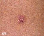 basal cell carcinoma
