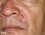 basal cell carcinoma