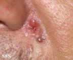 basal cell carcinoma