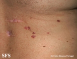 basal cell carcinoma