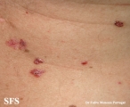 basal cell carcinoma