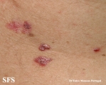 basal cell carcinoma