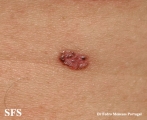 basal cell carcinoma