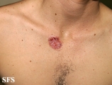 basal cell carcinoma